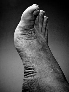 foot odor remedy