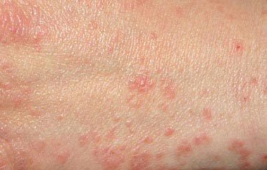 home remedy for scabies