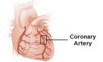 Blockage in the coronary arteries of the heart may be linked to smoking, unhealthy eating and obesity.
